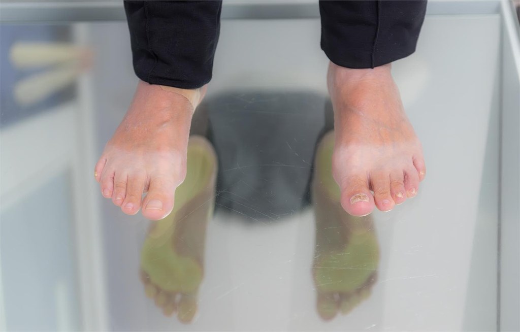 ¿Cuáles son las causas del pie de atleta y cómo corregirlo?