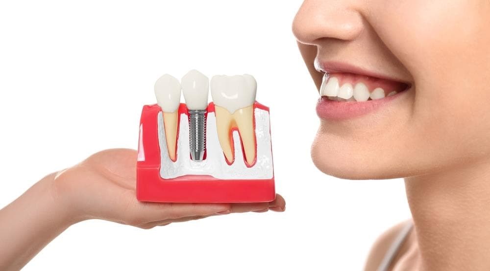 ¿Cuánto cuesta un implante dental?
