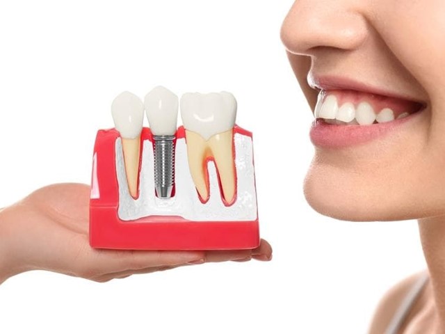 ¿Cuánto cuesta un implante dental?