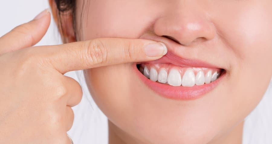 Tratamiento de periodoncia para el cuidado de las encías en Muros