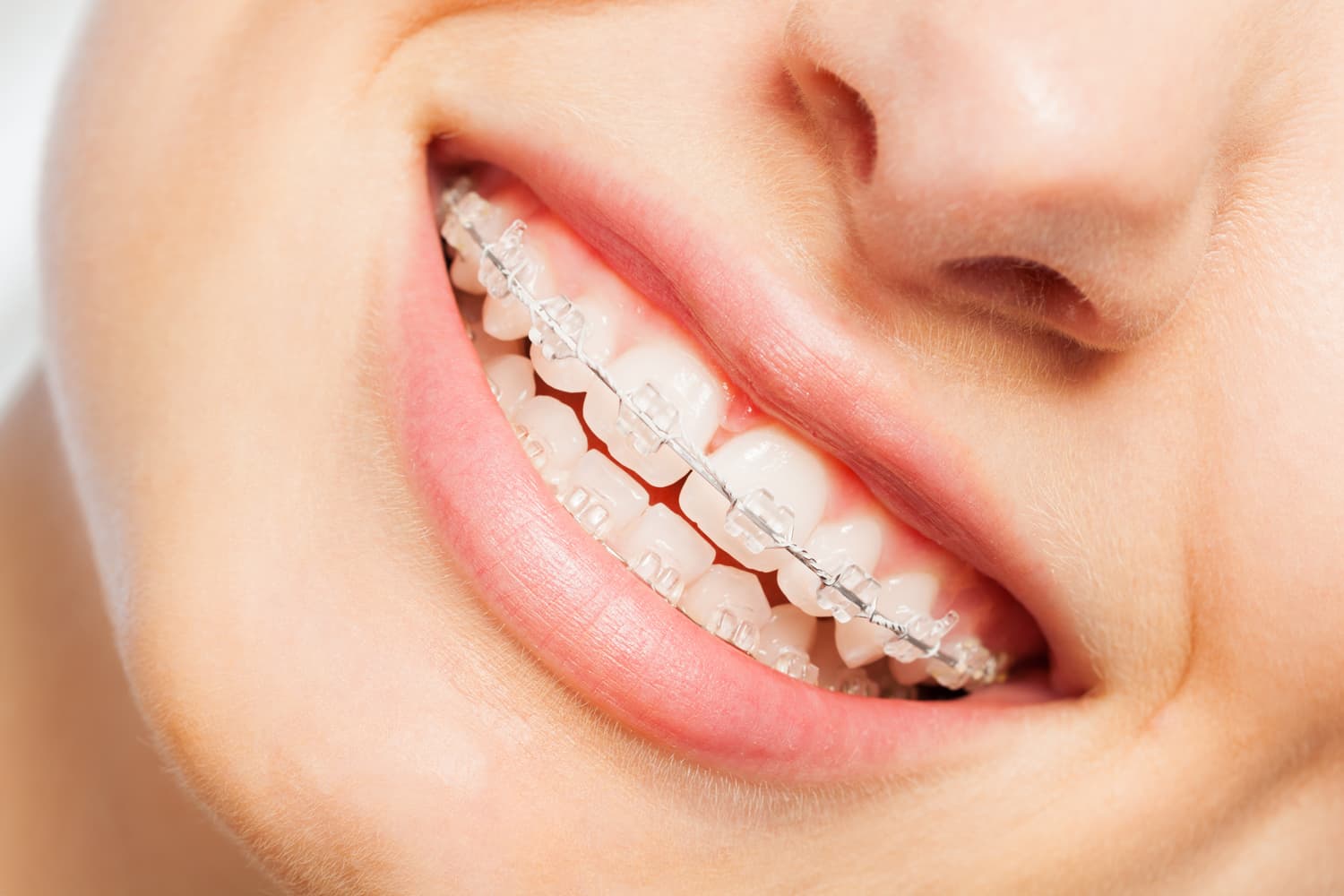  ¡Logra unos dientes alineados con los aparatos dentales!