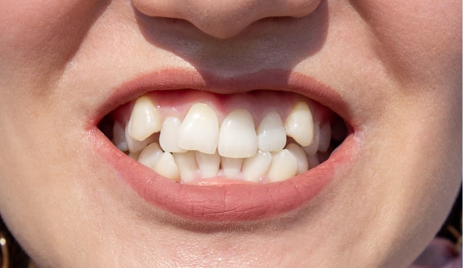 Dientes desalineados antes del tratamiento de ortodoncia en Muros