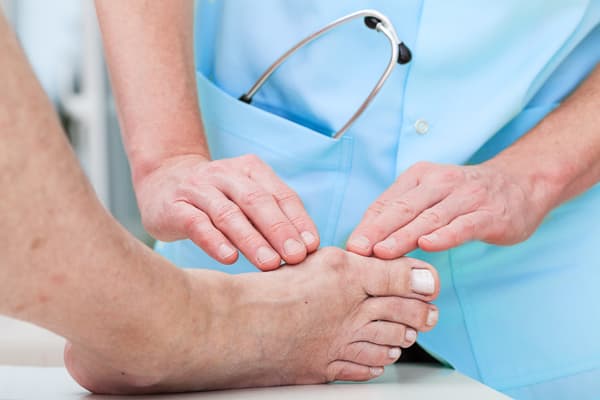 Juanetes tratados en la consulta de podología geriátrica de Muros y Milladoiro