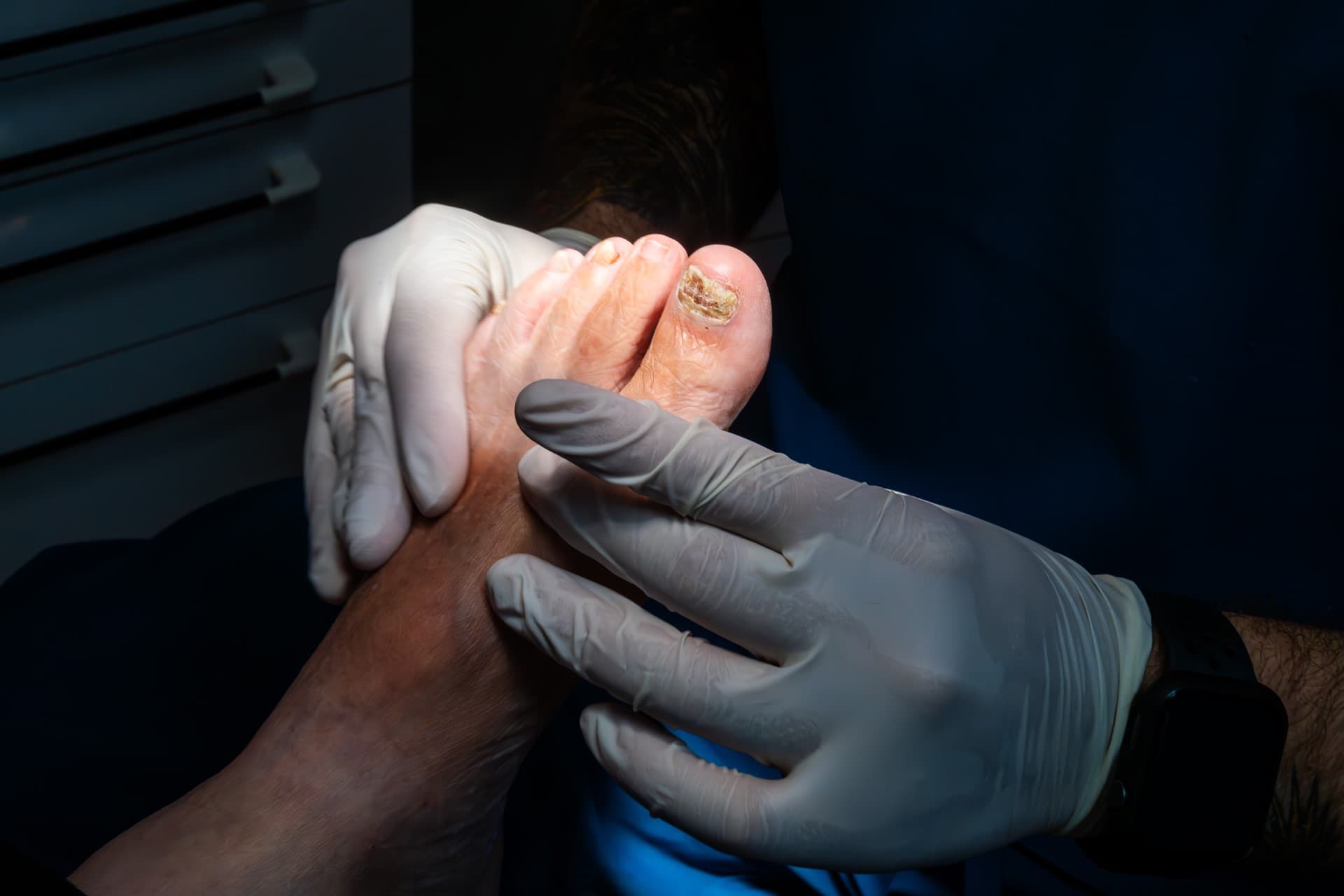 Tratamiento de uñas encarnadas en personas mayores en Muros y Milladoiro