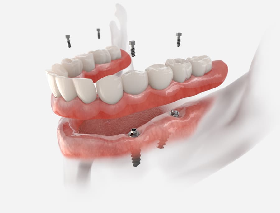 Prótesis dental fija colocada sobre las piezas adyacentes en Muros