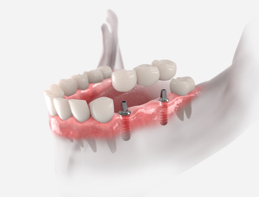 Prótesis híbrida sobre implantes dentales en la clínica de Muros