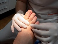 ¿Qué son y cómo tratar los papilomas?